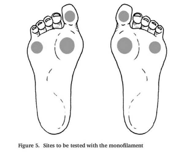 Monofilament testing in diabetic foot – GPnotebook